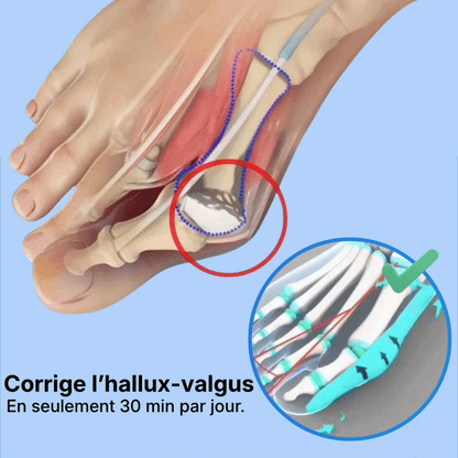Correcteur Hallux-Valgus - Soulagement Instantané