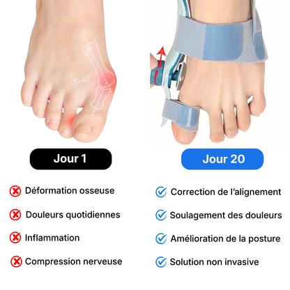 Correcteur Hallux-Valgus - Soulagement Instantané